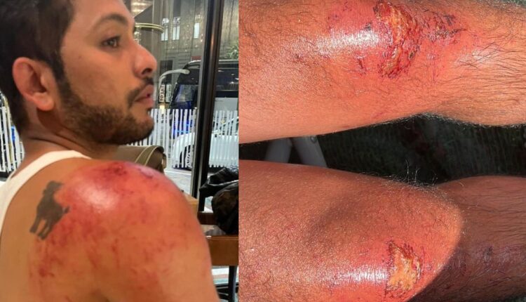 Nishant Bhat gets injured during a stunt in Khatron Ke Khiladi 12